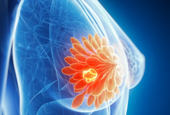 Advanced Symptoms of Breast Cancer