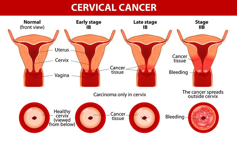 Best Hospital For Cervical Cancer Treatment In Delhi