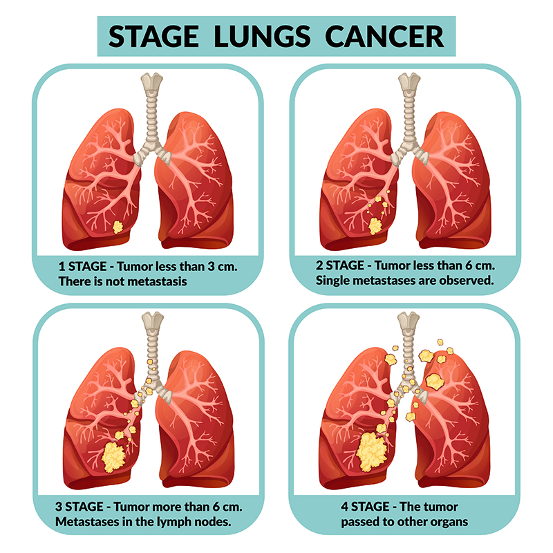 Lung Cancer Staging Prognosis Infographics Lung Cancer Treatment Cell 